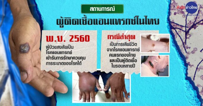 ติดเชื้อแอนแทรกซ์