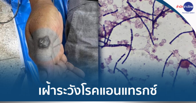โรคแอนแทรกซ์