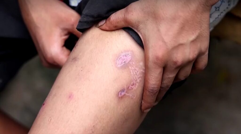 scar from dog bite